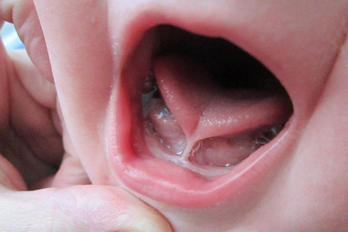 the benefits of tongue and lip tie release for children in airdrie